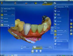CEREC-Software: digitale Konstruktion einer Krone am Bildschirm